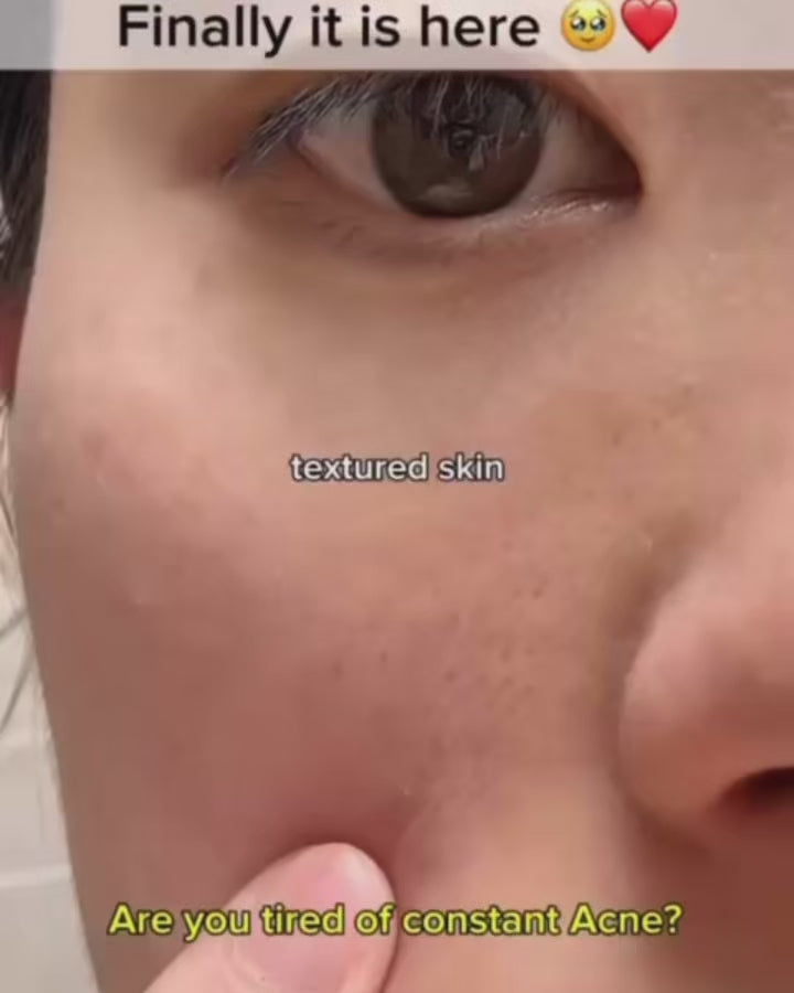 Remove Blackheads & Get Instant Glow in 5 Minutes – Avocado Bubble Mask